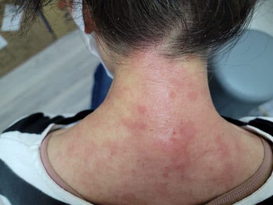 濕疹eczema