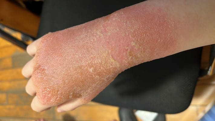 濕疹eczema
